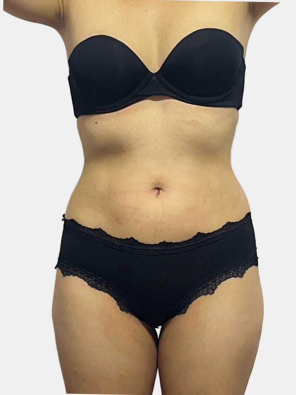 Después de Reducción y Moldeo